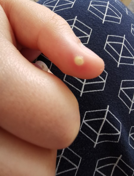 A white bump on a thumb.