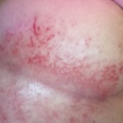 A rash on a chest.