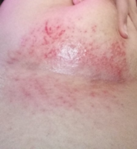 A rash on a chest.