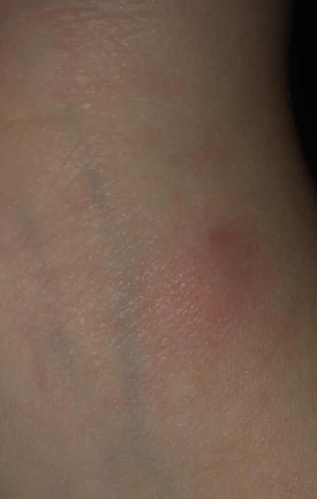 A red bug bite on an arm.
