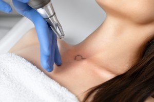 A woman receiving a laser treatment for removing her tattoo.