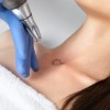 A woman receiving a laser treatment for removing her tattoo.