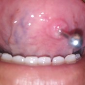 Lump Under Bottom Tongue Piercing?