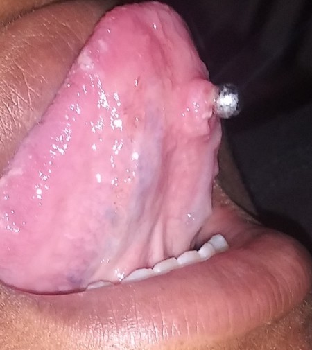 Lump Under Bottom Tongue Piercing?