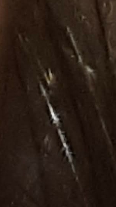 Getting Rid of Bugs In Hair?