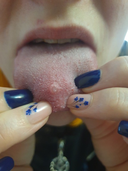 An inflamed tongue piercing.