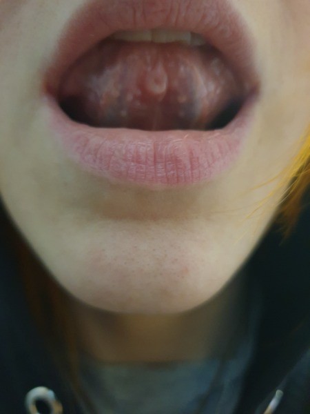 An inflamed tongue piercing.