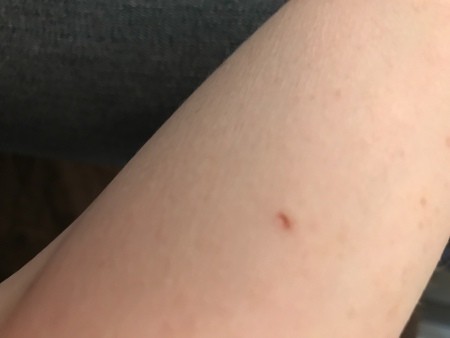 A small scrape on an arm.