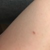A small scrape on an arm.