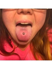 A red spot around a tongue piercing.