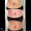 Photos showing progressive changes to a stomach.