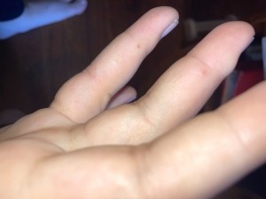 Swollen fingers from an insect bite.