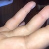 Swollen fingers from an insect bite.