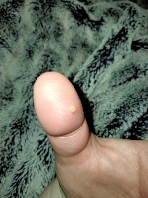 A painful white bump on a thumb.