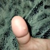 A painful white bump on a thumb.