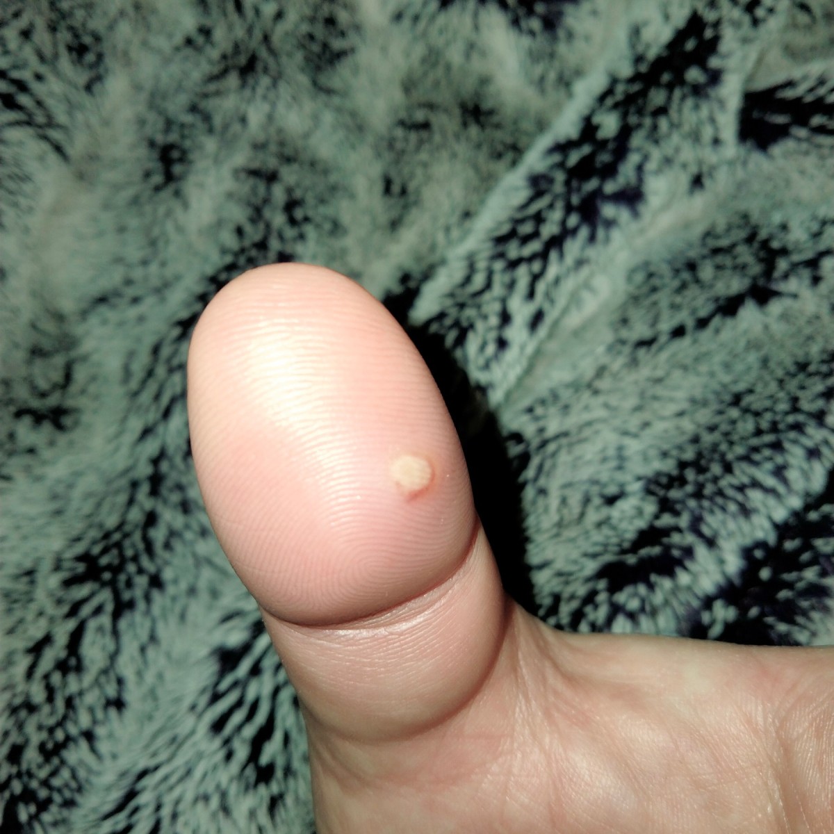 Why Is There A Painful White Bump On My Finger