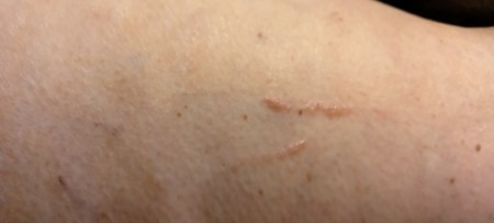 Scratches on a leg