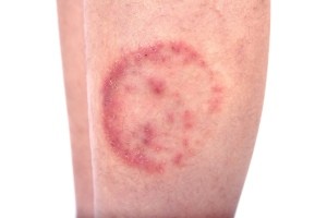 A ringworm infection on a person's leg.