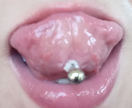 Infected Tongue Piercing?